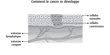 Schéma de la façon dont le cancer se développe