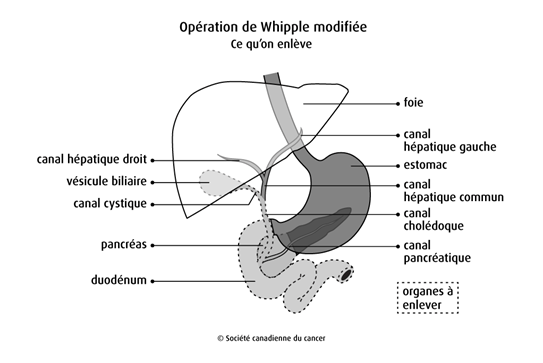 Opération de Whipple modifiée