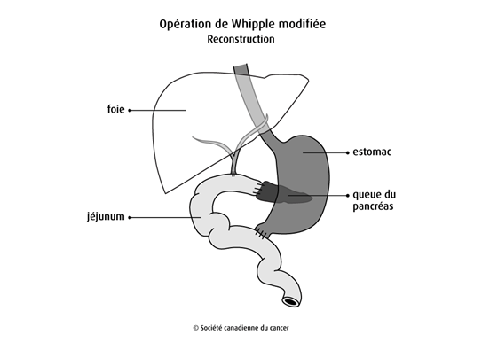 Opération de Whipple modifiée, reconstruction