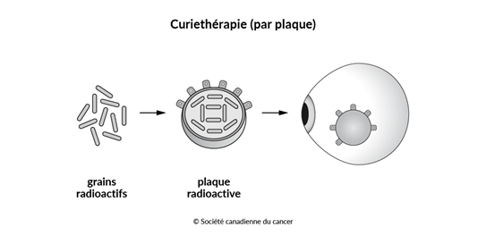 Schéma de la curiethérapie (radiothérapie par plaque) de l’œil