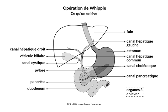 Schéma de l'opération de Whipple, ce qu'on enlève